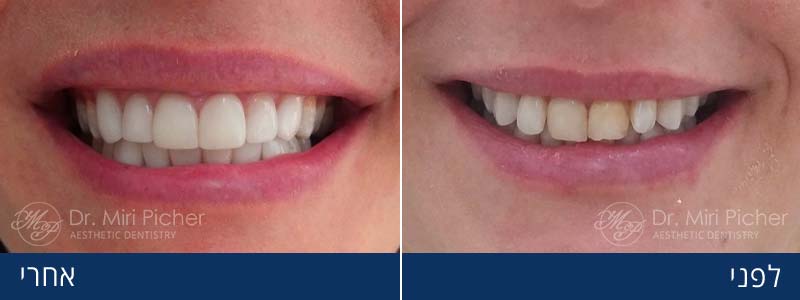 ציפוי שיניים בחרסינה לפני ואחרי